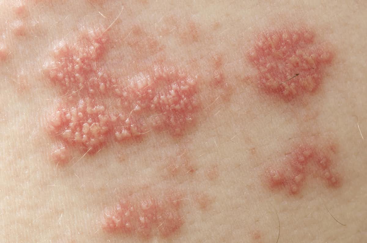 Explainer: how do you get shingles and who should be vaccinated against it?