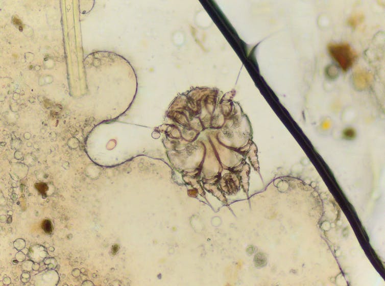 Scabies: a neglected parasitic disease we already know how to treat