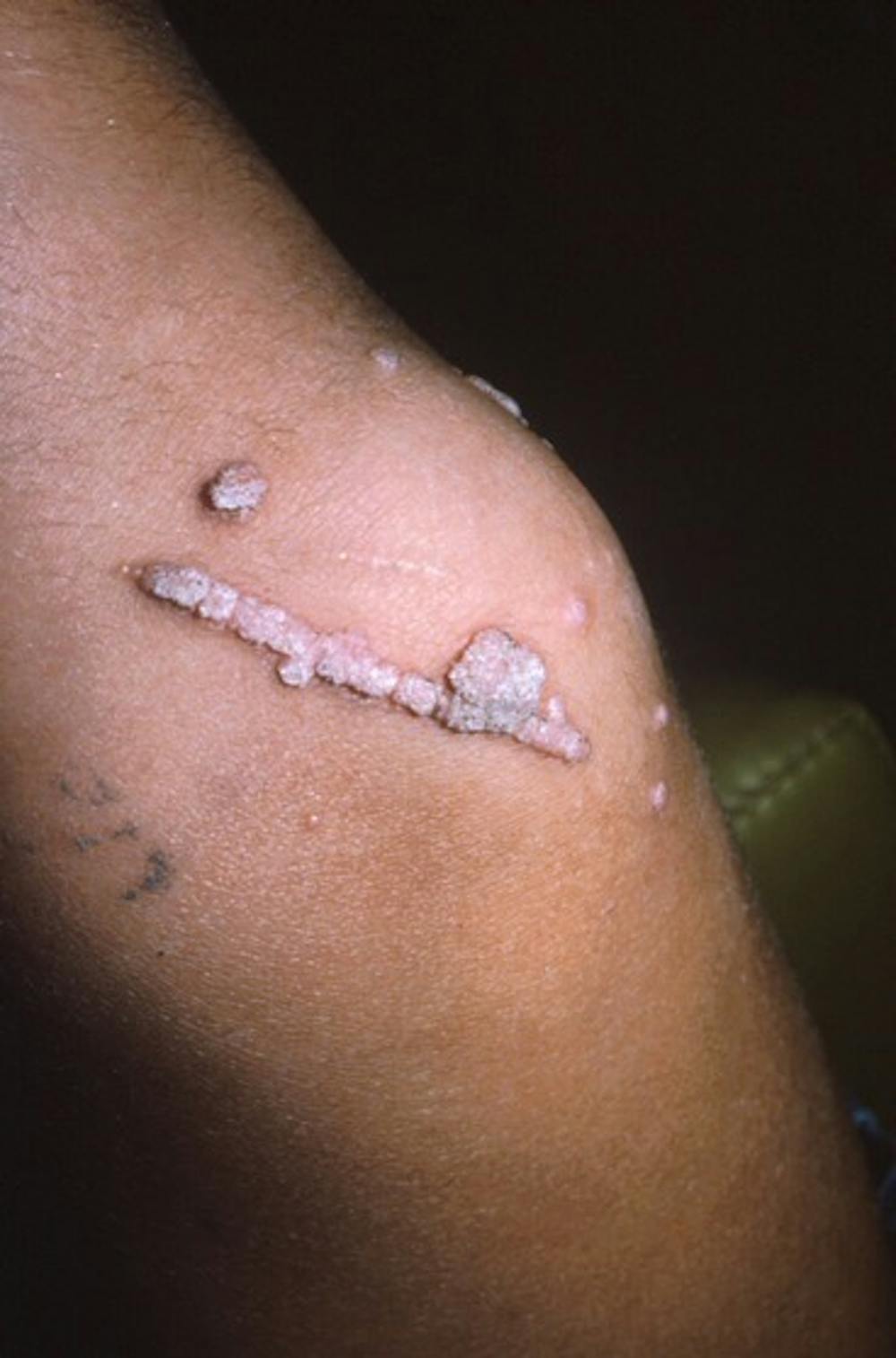 human papillomavirus on knee