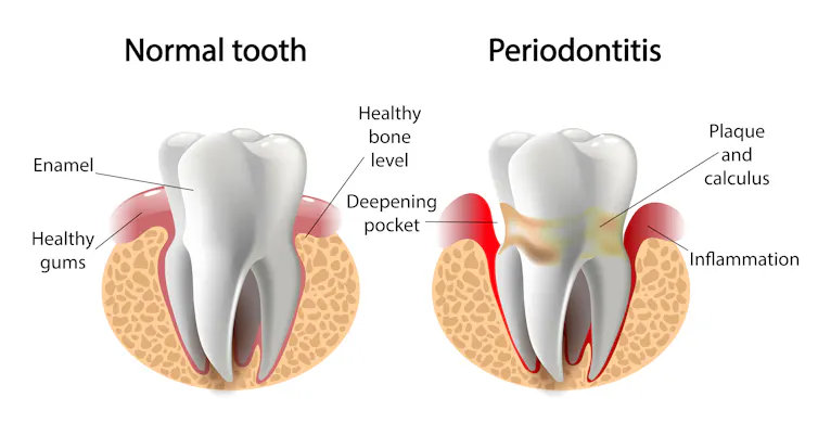 Rotting Gums Periodontitis: why we need a vaccine for gum disease