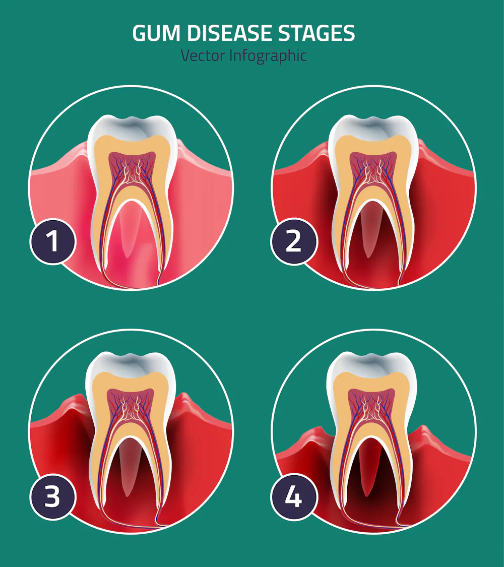 Rotting Gums Periodontitis: why we need a vaccine for gum disease