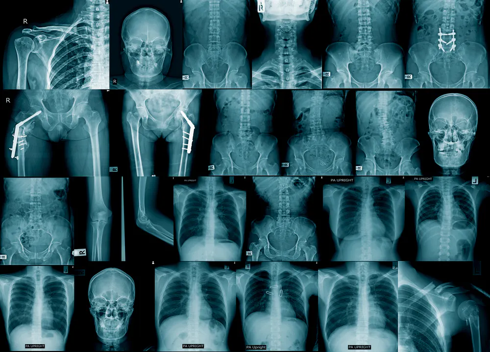 Why Older People Get Osteoporosis And Have Falls