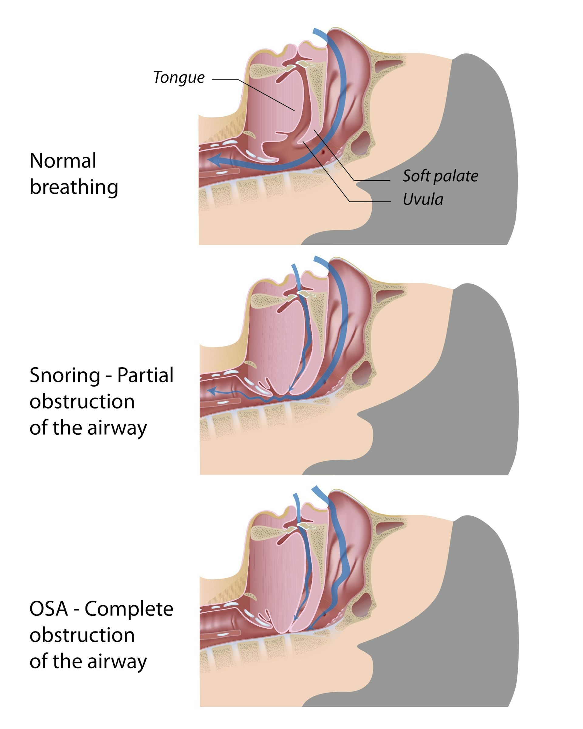 Snoring noise store