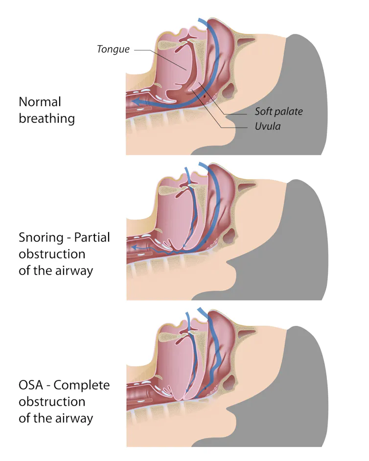 Health Check: is snoring anything to worry about?