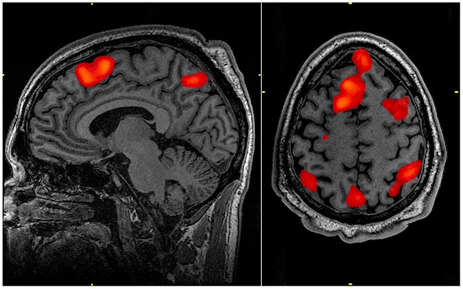 fMRI diagram -- different areas of a black and white human brain lit up like a heatmap showing where oxygen is flowing