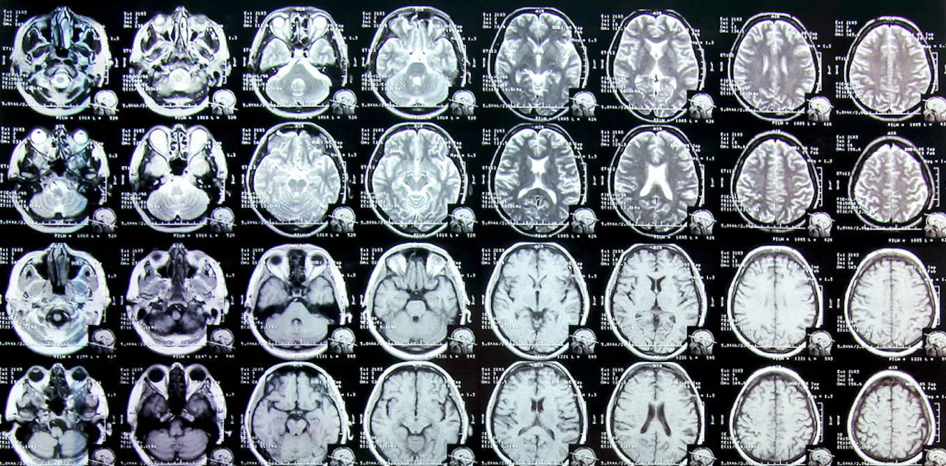 Imaging study confirms differences in ADHD brains