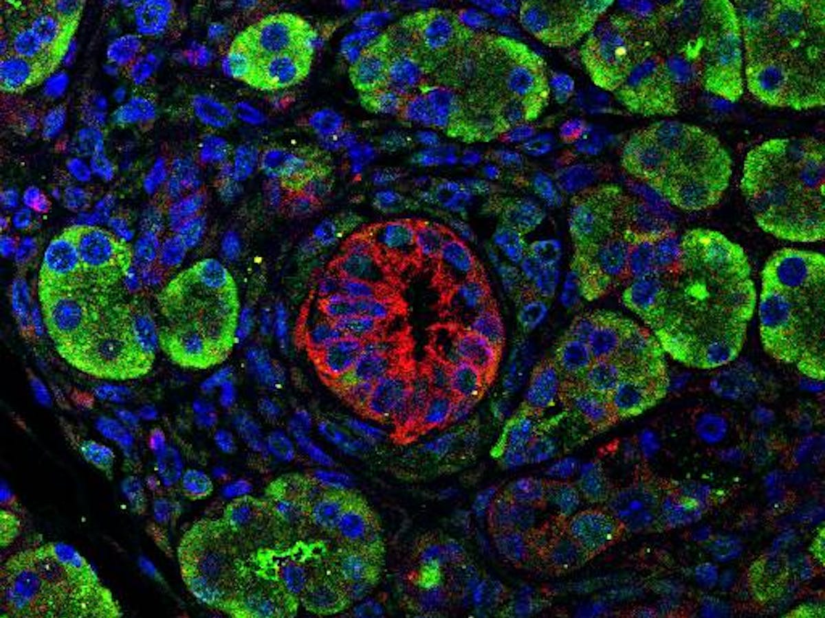 Pancreatic Cancer Wouldn T Be So Deadly If We Could Just