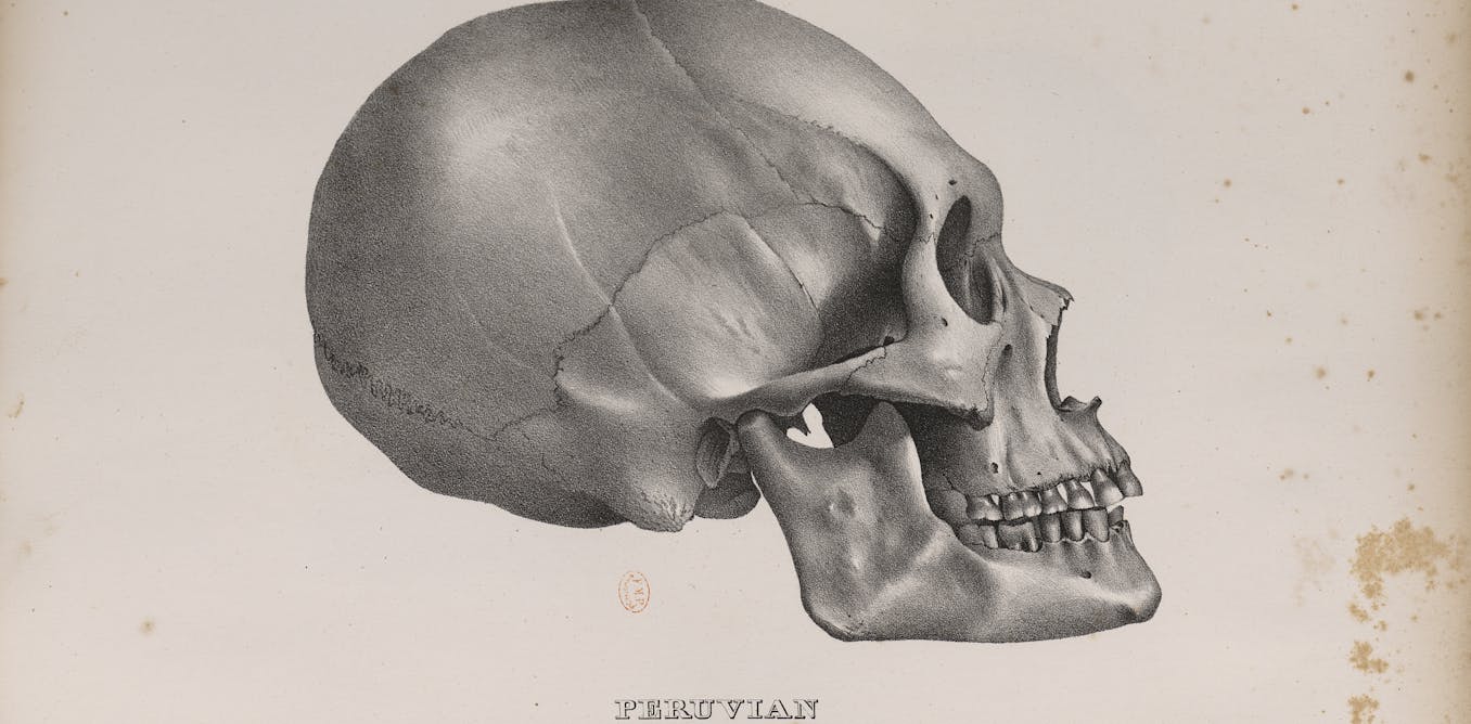 Deformation Cranienne Pratiquee Par Les Incas Elle Est Aussi Coutume Universelle Deformation Cranienne Pratiquee Par Les Incas Elle Est Aussi Coutume Universelle