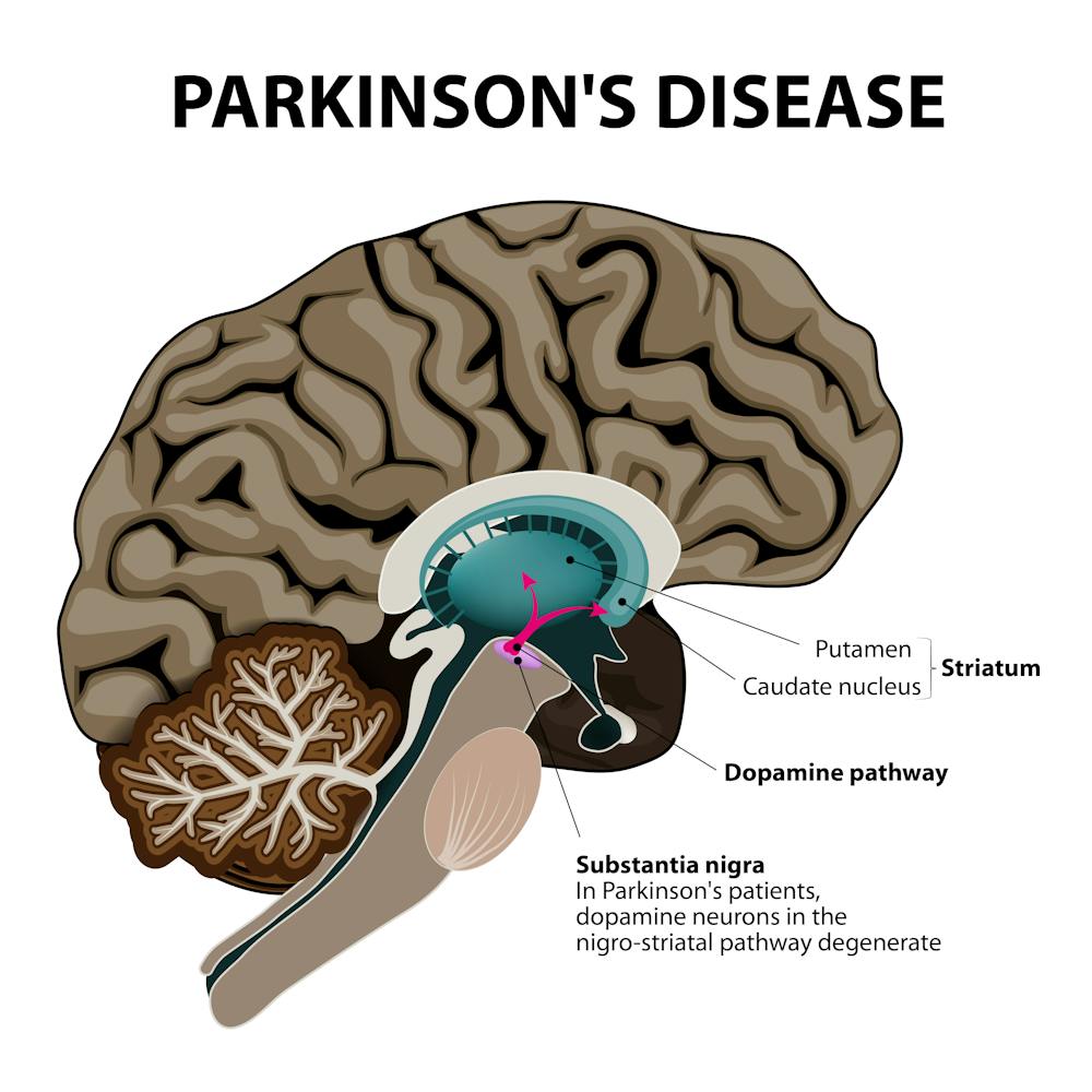 From Blood Letting To Brain Stimulation 200 Years Of Parkinson S Disease Treatment