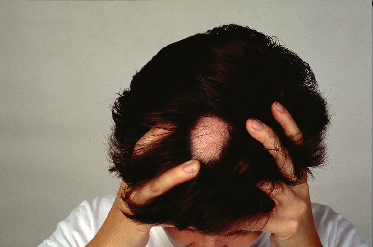 Explainer: what causes alopecia areata and can you treat this type of hair  loss?