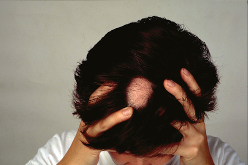 Explainer What Causes Alopecia Areata And Can You Treat