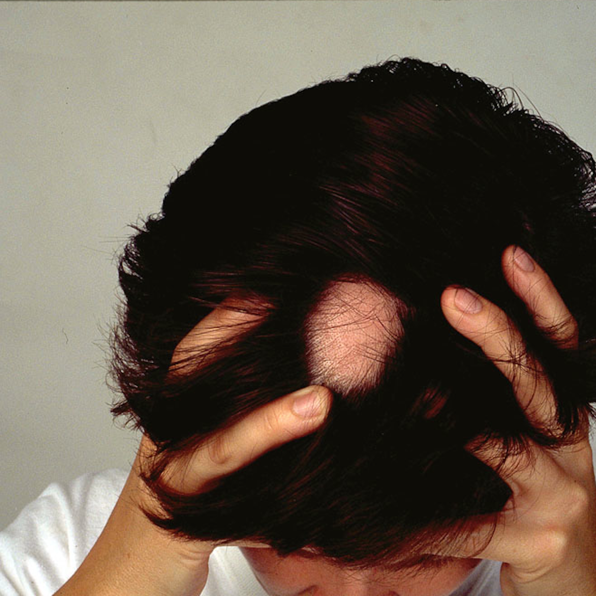 Explainer What Causes Alopecia Areata And Can You Treat This Type