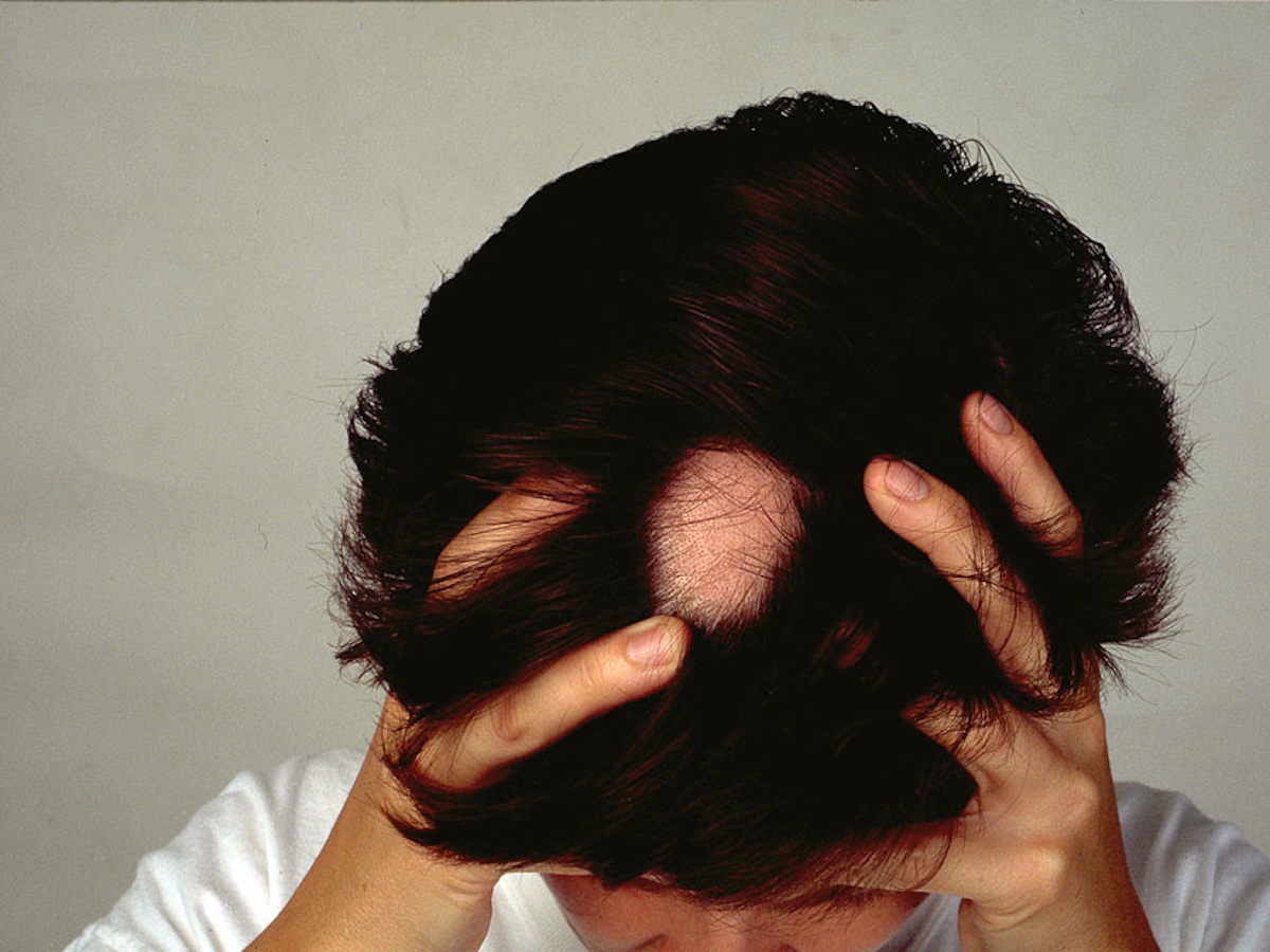 Explainer: what causes alopecia areata and can you treat this type of hair  loss?
