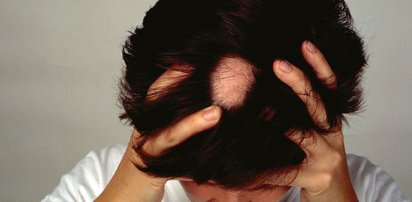 Explainer What Causes Alopecia Areata And Can You Treat This Type
