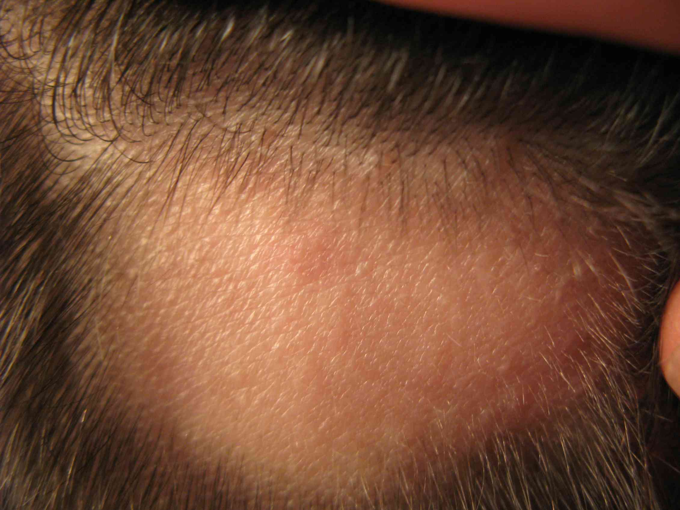 Красный лоб у мужчины. Фолликулит, гипертрихоз. Очаговая алопеция (alopecia Areata). Трихофития (стригущий лишай).
