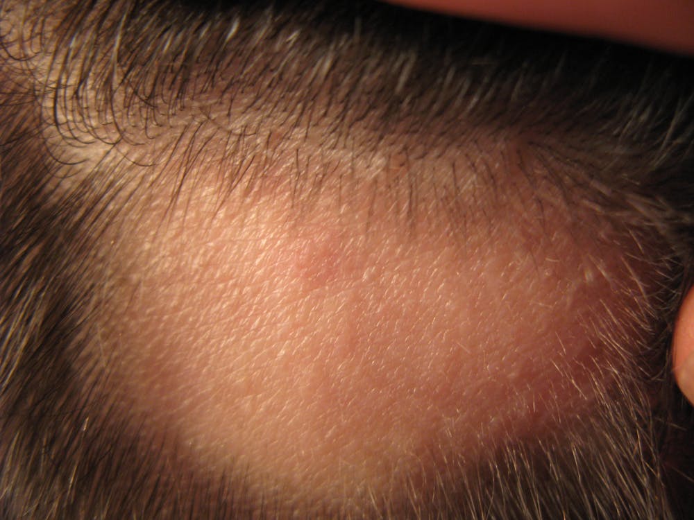 Explainer What Causes Alopecia Areata And Can You Treat This Type