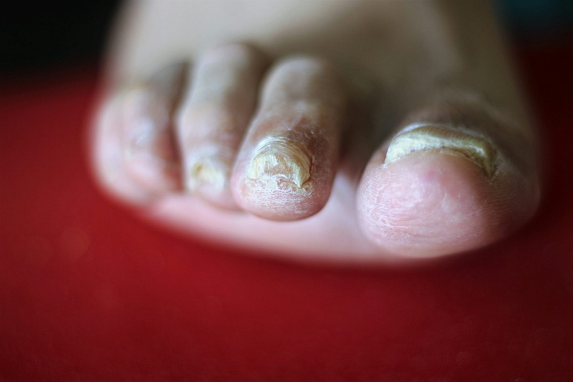 Fungal nail infections  Healthify