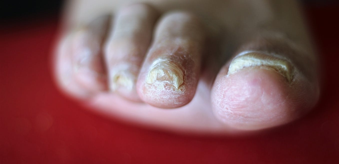 severe toenail fungus