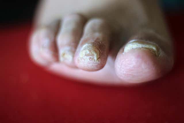 Explainer: why do we get fungal nail infections and how can we treat them?