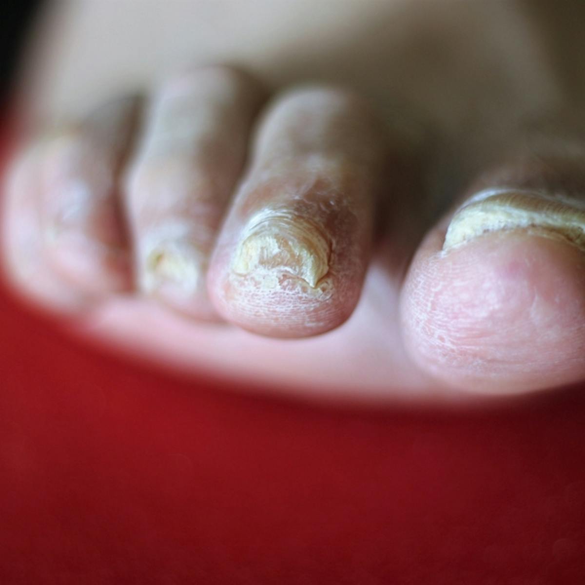 Latest Information About Best Fungal Nail Treatment Uk