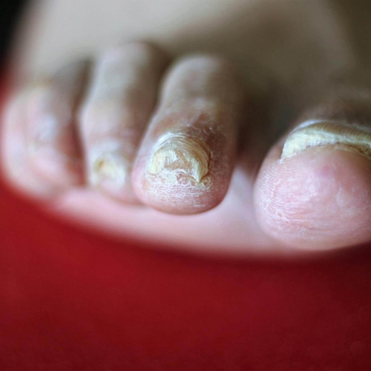 nail fungus cure só)