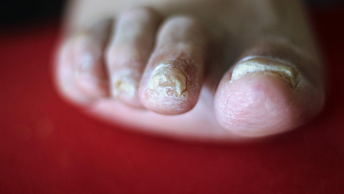 toe nail fungus australia