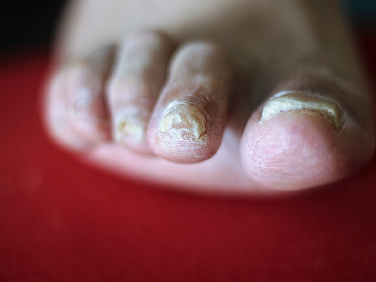 How to care for a nail that is falling off Explainer Why Do We Get Fungal Nail Infections And How Can We Treat Them
