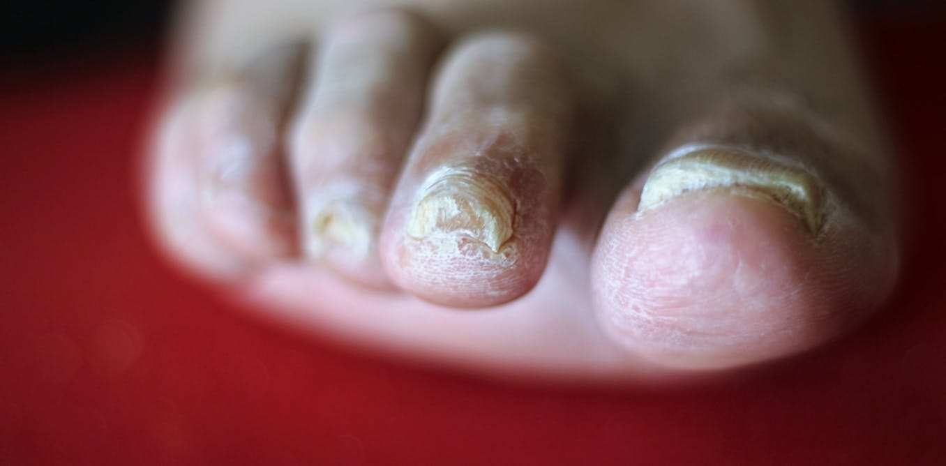 Explainer Why Do We Get Fungal Nail Infections And How Can We Treat Them Explainer Why Do We Get Fungal Nail Infections And How Can We Treat Them
