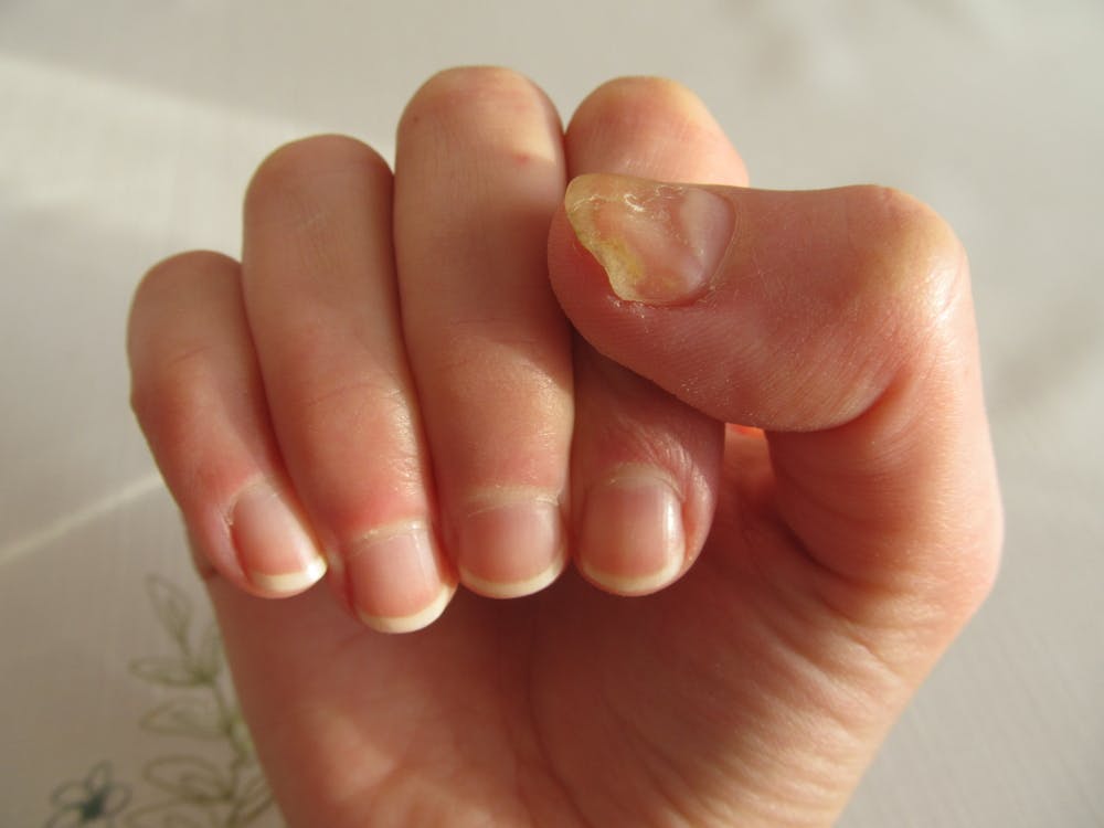 Explainer: why do we get fungal nail infections and how can we treat them?