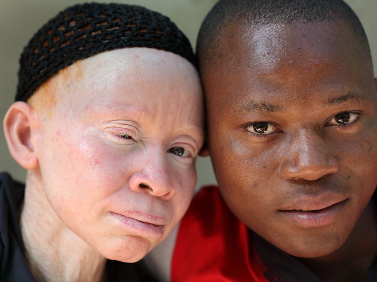 Dating Woman Albinos.)
