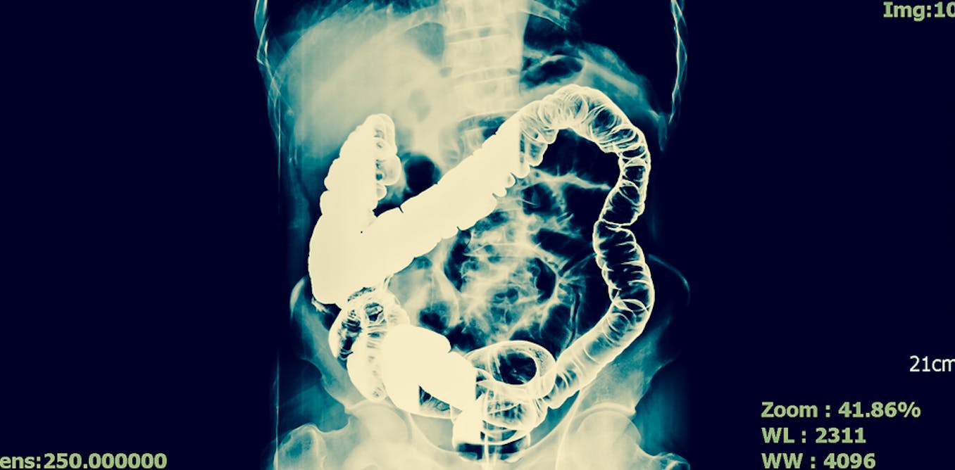 Affordable Health Care >> Hirschsprung’s disease explained Affordable Health Care >> Hirschsprung’s disease explained