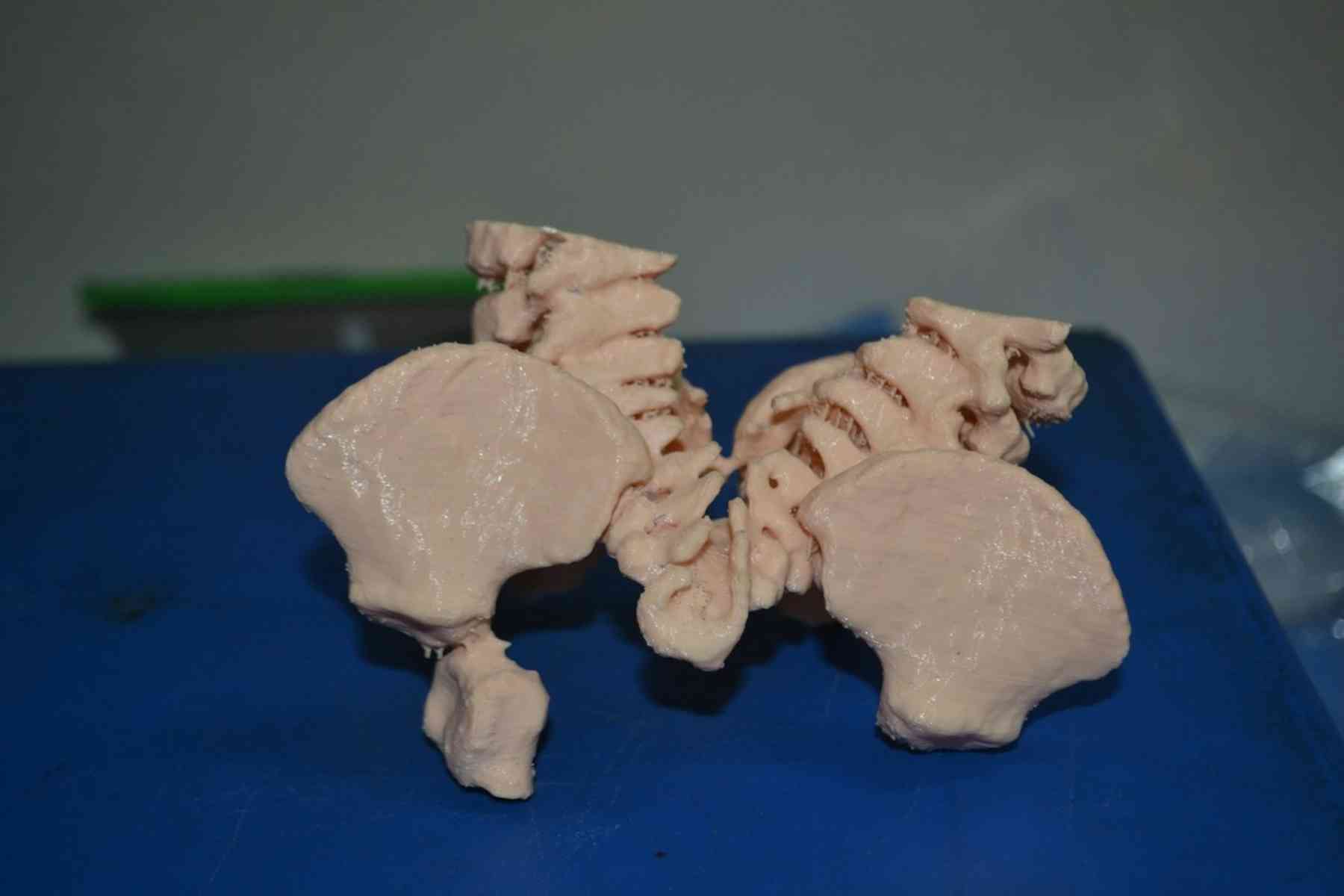 How 50 medical experts separated Kenyan conjoined twins in 23-hour surgery