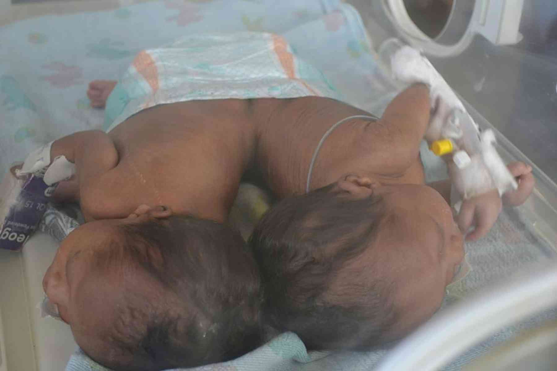 How 50 Medical Experts Separated Kenyan Conjoined Twins In 23 Hour Surgery