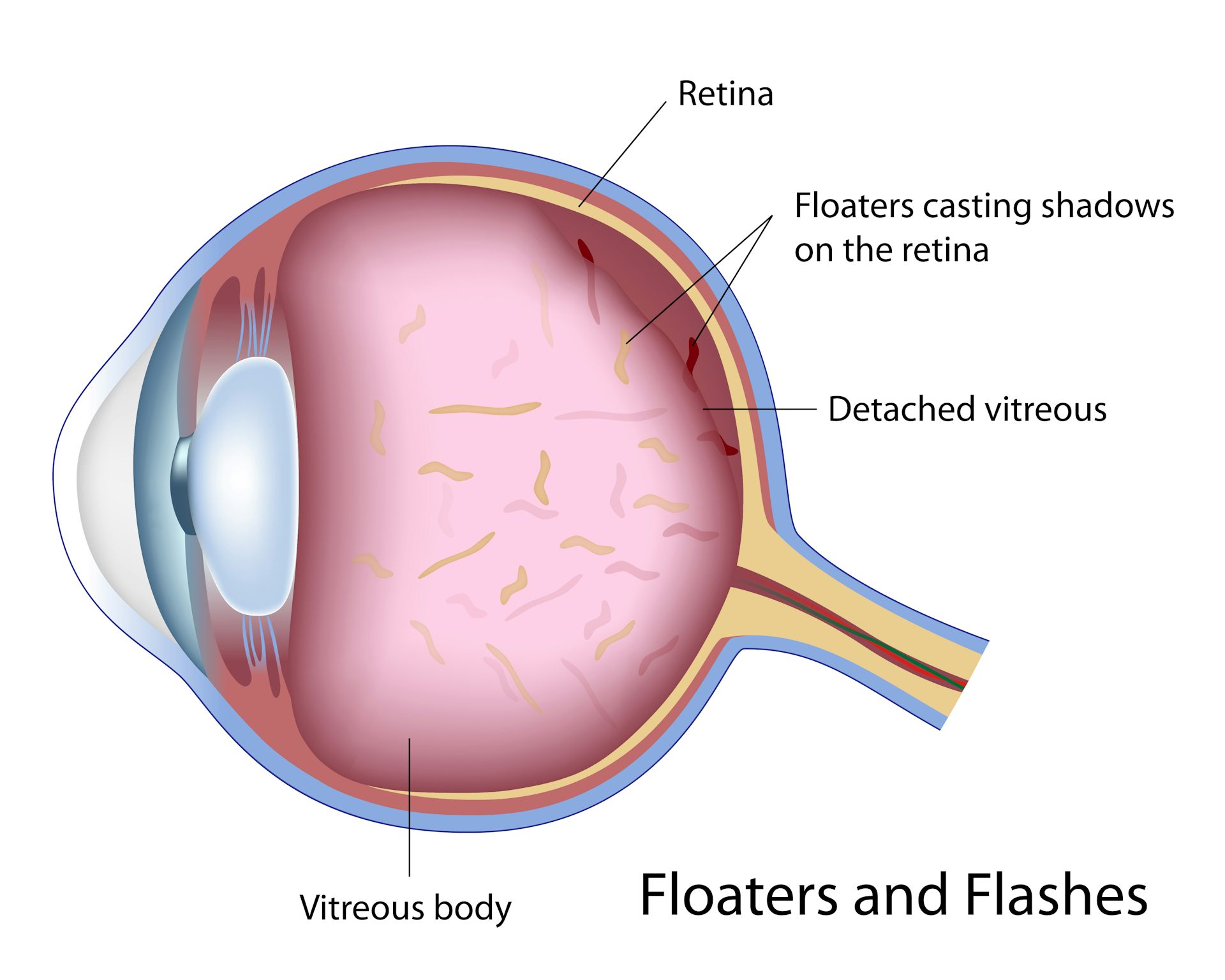 yag laser eye