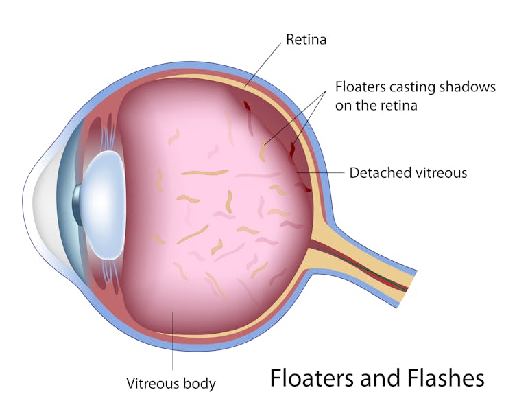 The Laser Beam That Can Get Rid Of Those Pesky Eye Floaters The Laser Beam That Can Get Rid Of Those Pesky Eye Floaters
