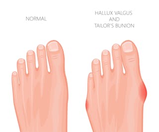 Explainer What Is A Bunion And Do I Need To Get Mine Treated