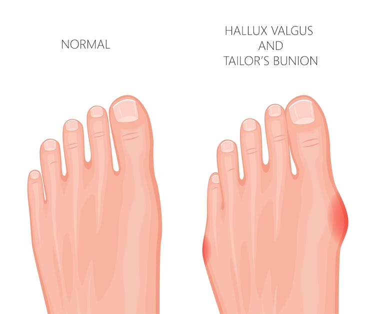 Explainer What Is A Bunion And Do I Need To Get Mine Treated Explainer What Is A Bunion And Do I Need To Get Mine Treated