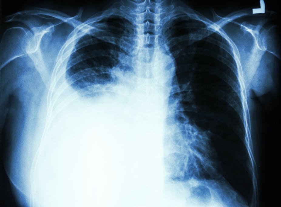 Vitamin B Supplements Linked To Lung Cancer Heres Why You
