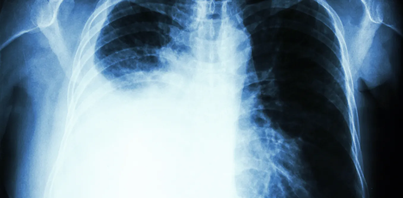 Vitamin B supplements linked to lung cancer – here's why you probably don't need to worry