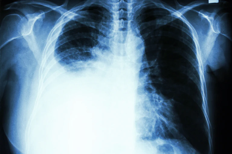 Vitamin B supplements linked to lung cancer – here's why you probably don't need to worry
