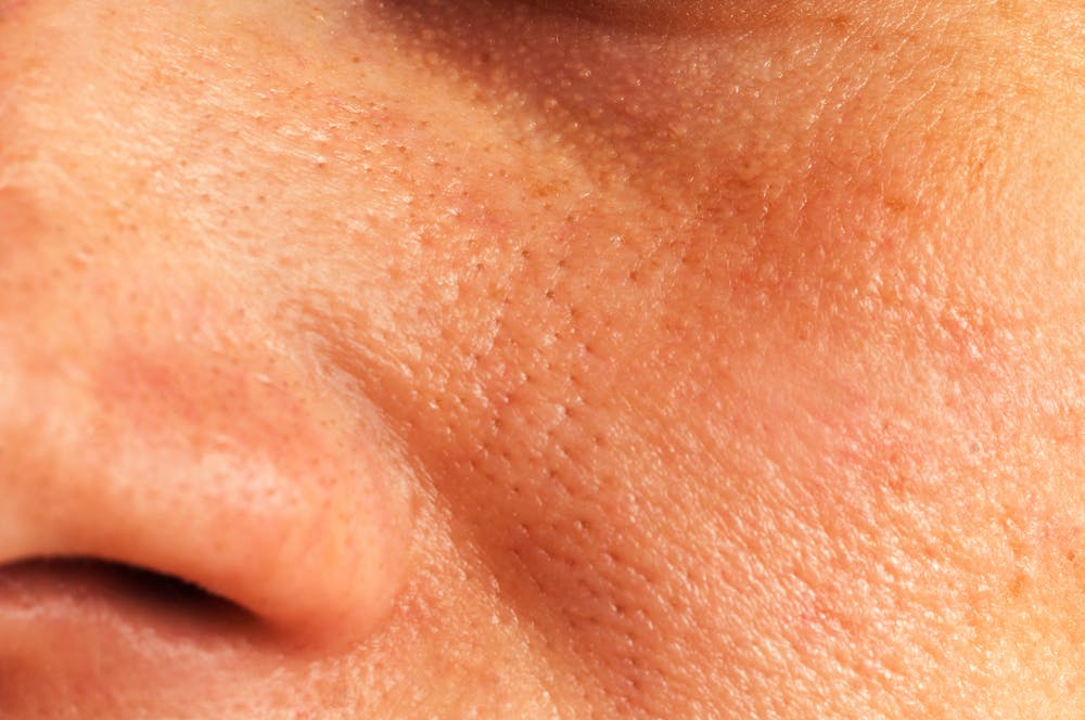 Need to dispose of huge pores? Attempt these