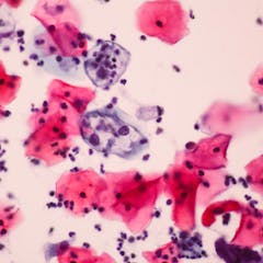 Pap Smear Berita Riset Dan Analisis The Conversation Laman 1 Pap Smear Berita Riset Dan Analisis The Conversation Laman 1