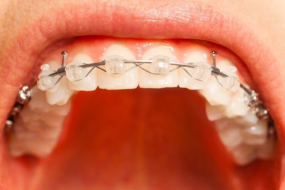 gums misalignment orthodontics swollen theconversation influenced
