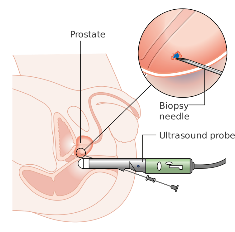 Krónikus prosztatagyulladás - Index Fórum - Prostatitis és autók