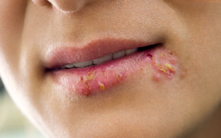 Adakah Herpes Boleh Merebak Dari Sampel Lipstik Yang Anda Cuba