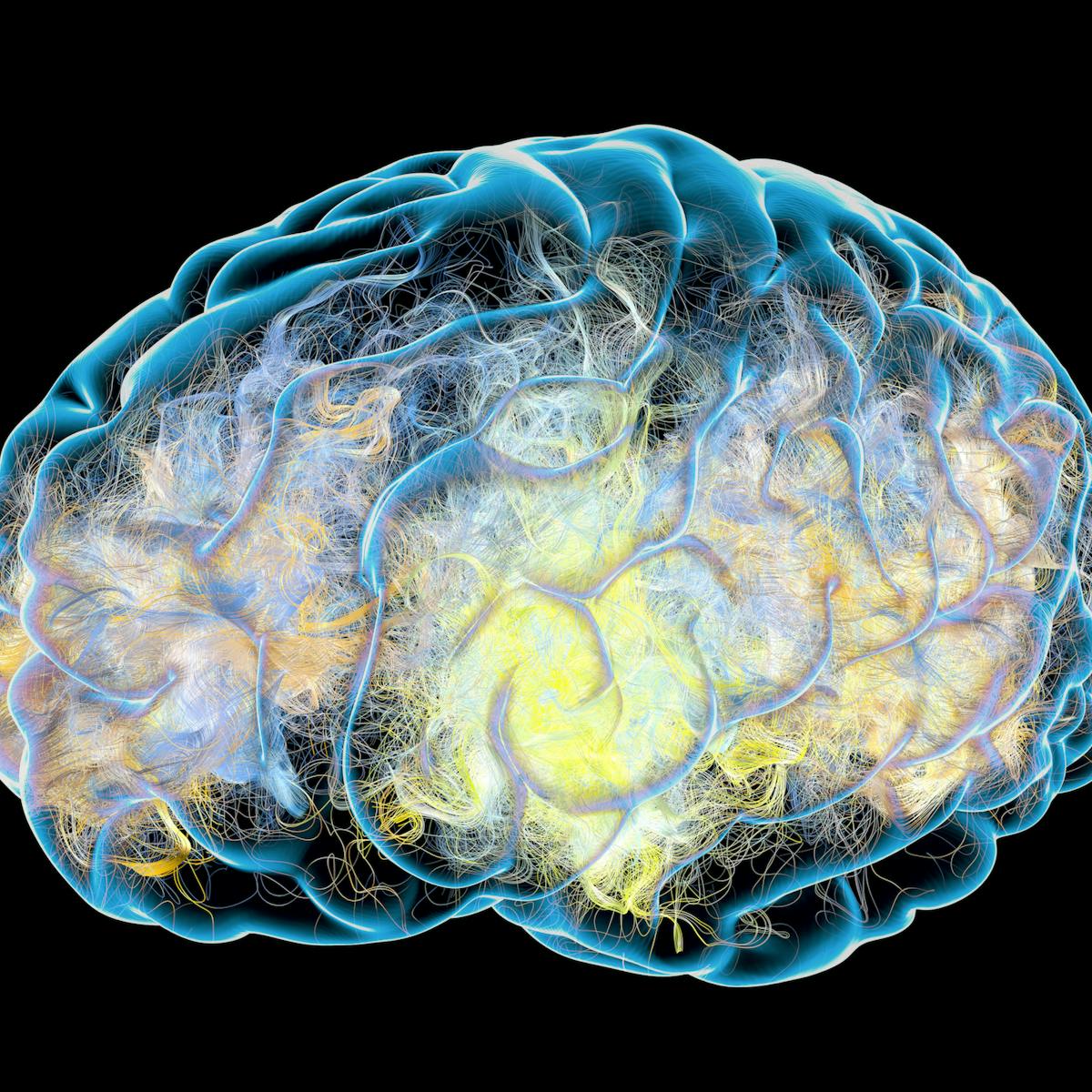 Here's what we think Alzheimer's does to the brain