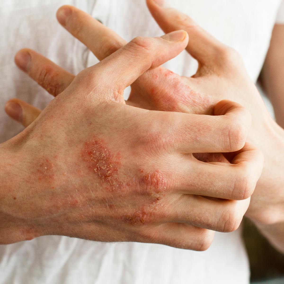 Why Simple School Sores Often Lead To Heart And Kidney Disease In Indigenous Children Why Simple School Sores Often Lead To Heart And Kidney Disease In Indigenous Children