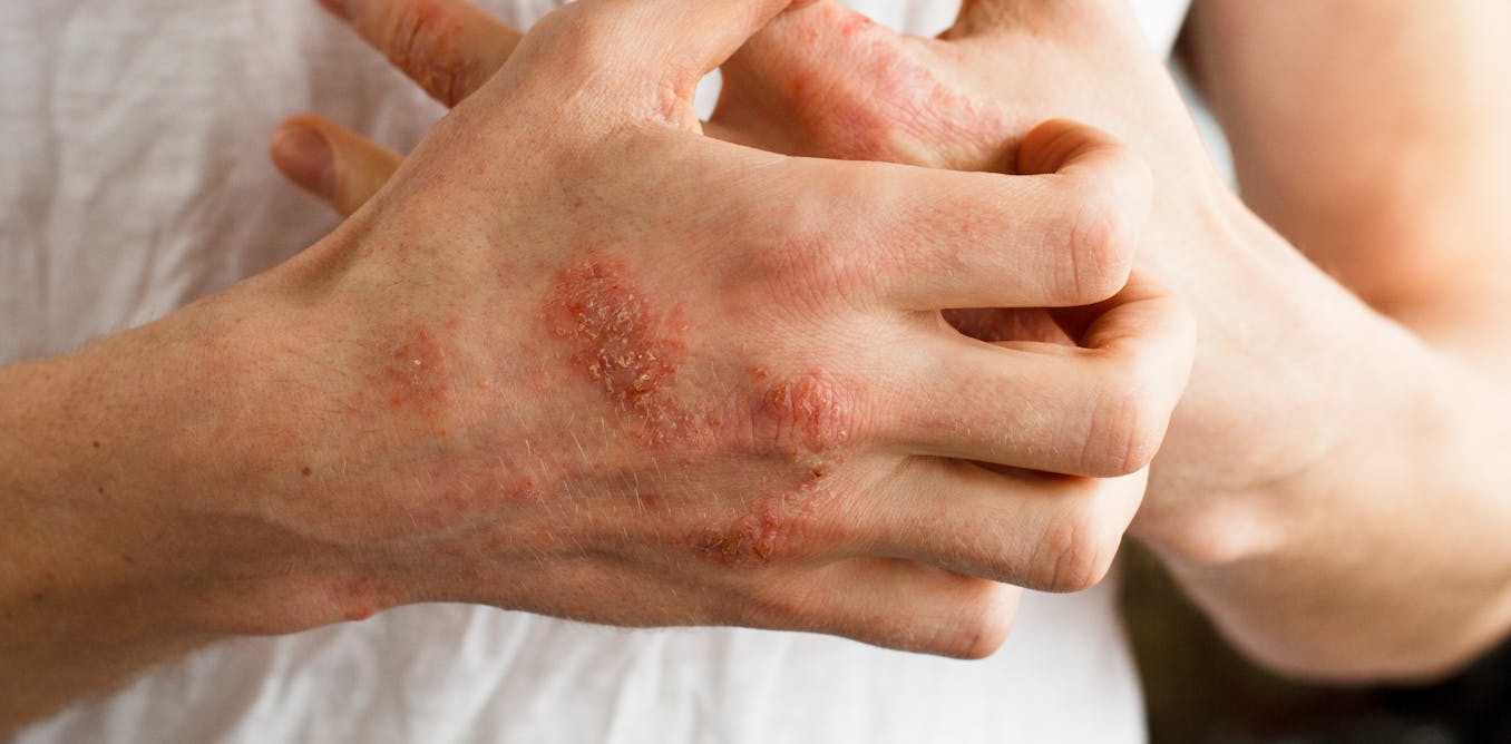 Why simple school sores often lead to heart and kidney Why simple school sores often lead to heart and kidney