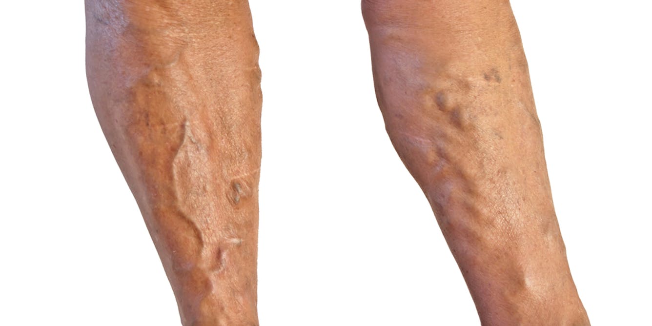What should I do to prevent varicose veins from coming back