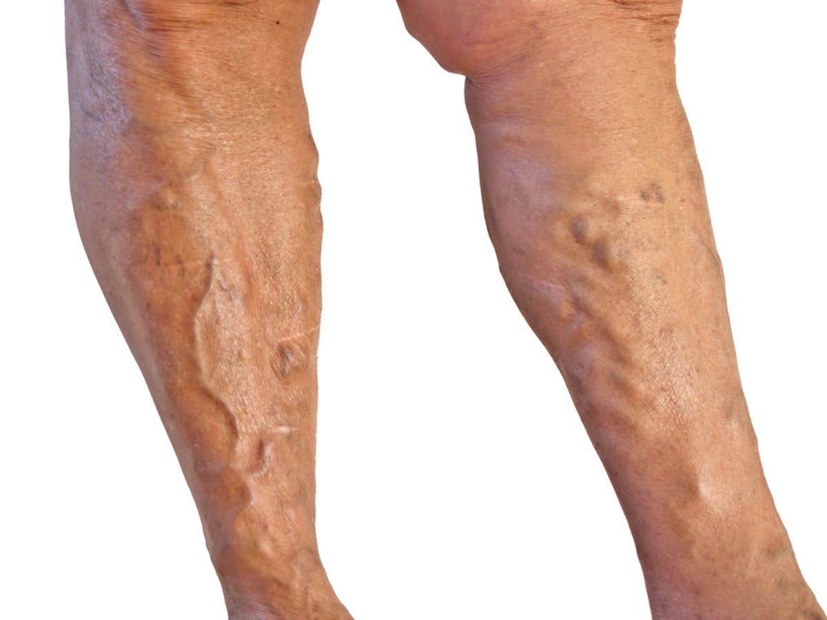 I've got varicose veins. What can I do about them?